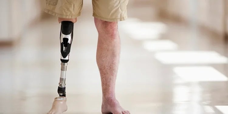 Une découverte révolutionnaire remet en question notre compréhension des membres fantômes