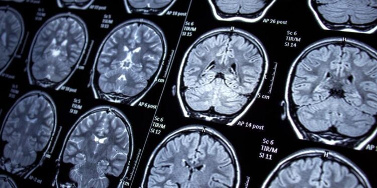 Des autopsies cérébrales révèlent un coupable potentiel de la maladie d&rsquo;Alzheimer