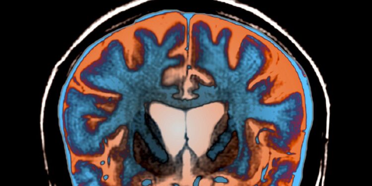 Une avancée contre Huntington soulève autant d&rsquo;espoirs que de questions